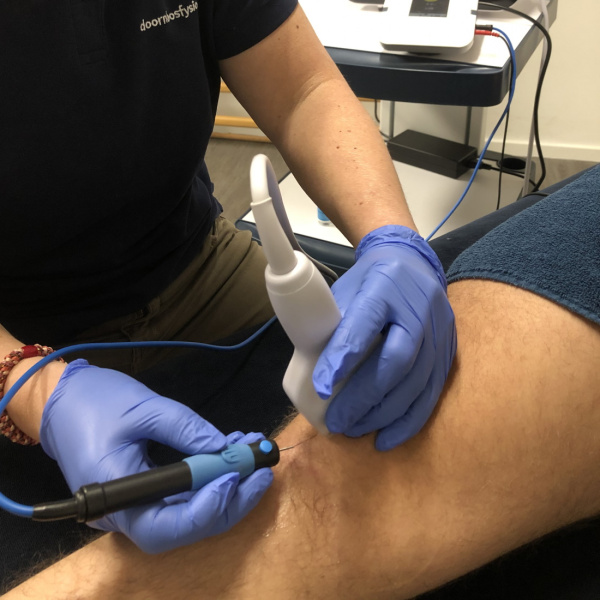 Kniepijn bij traplopen